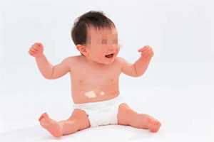 婴幼儿患白癜风怎么办