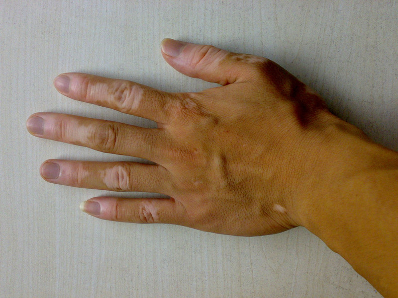 手部患上白癜风常见病因有哪些