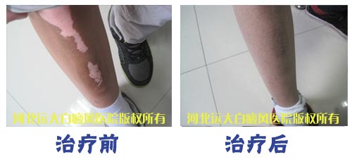 大腿上的白癜风各时期有什么症状呢
