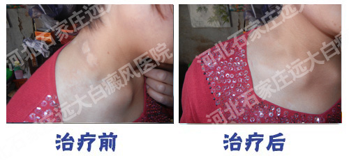 如何确诊白斑是不是局限型白斑