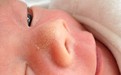 婴幼儿脸上有白点会是白癜风吗