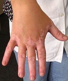 手指部位白斑治疗一直无效怎么办
