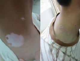 孩子得了白癜风一般多久能治好