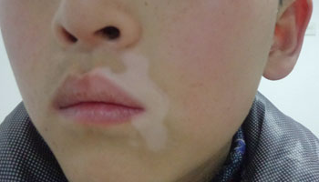 治疗白癜风的原则都有哪些