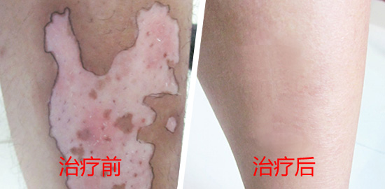 皮肤小伤会引发白癜风吗