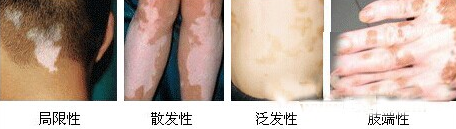 怎样才能更好得治疗腿部的白癜风呢