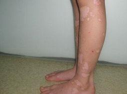 腿上有片白一个月自己能恢复正常色吗